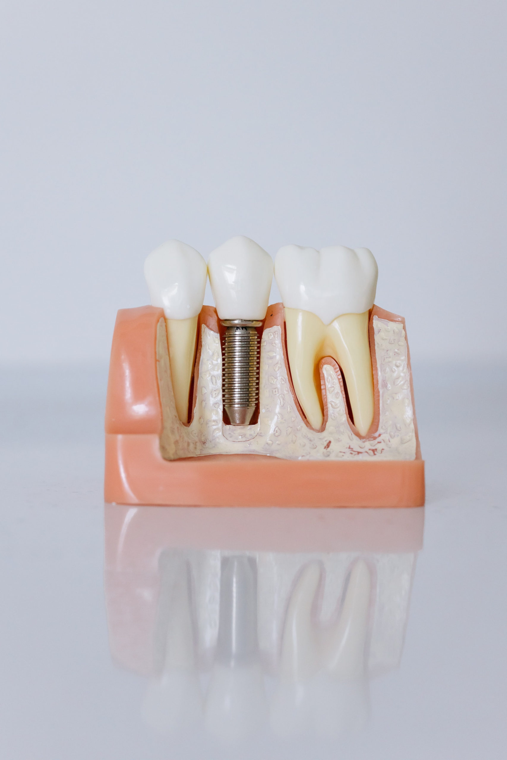 Qué son los implantes dentales y sus beneficios
