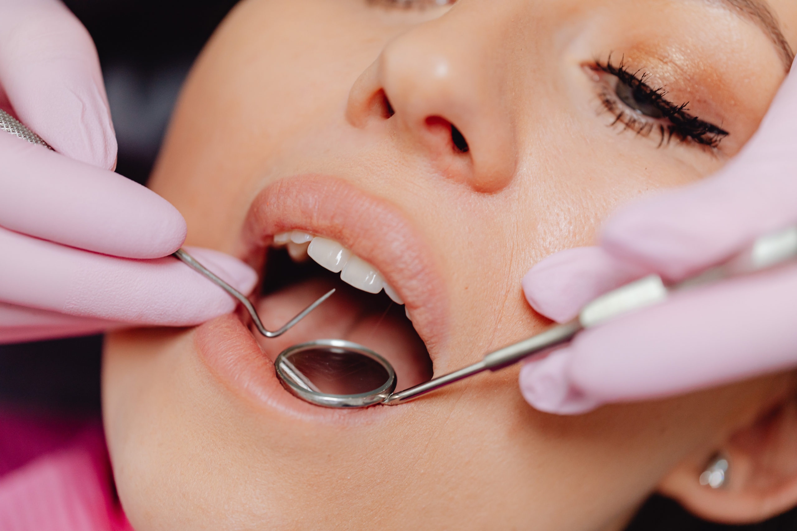 Qué es la limpieza dental y sus beneficios