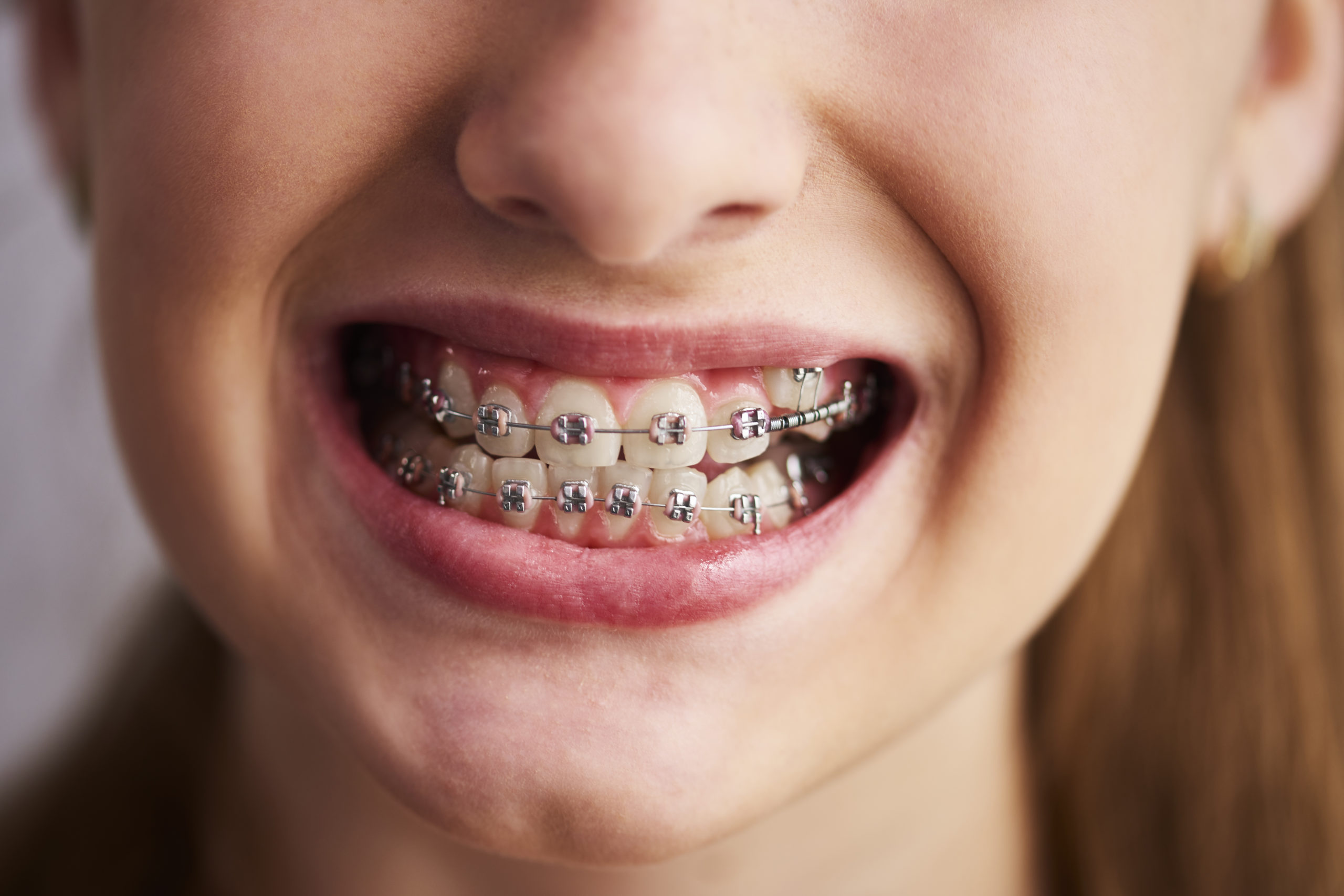 5 Preguntas frecuentes sobre la ortodoncia