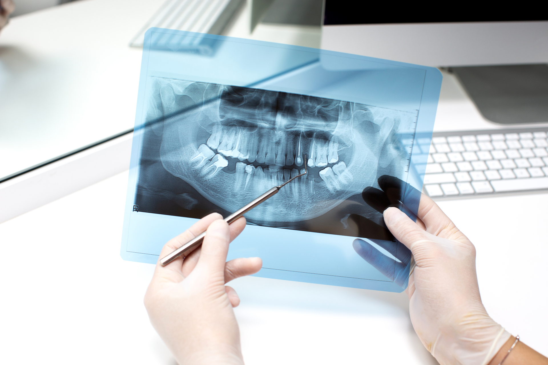 Cómo la endodoncia puede salvar un diente dañado