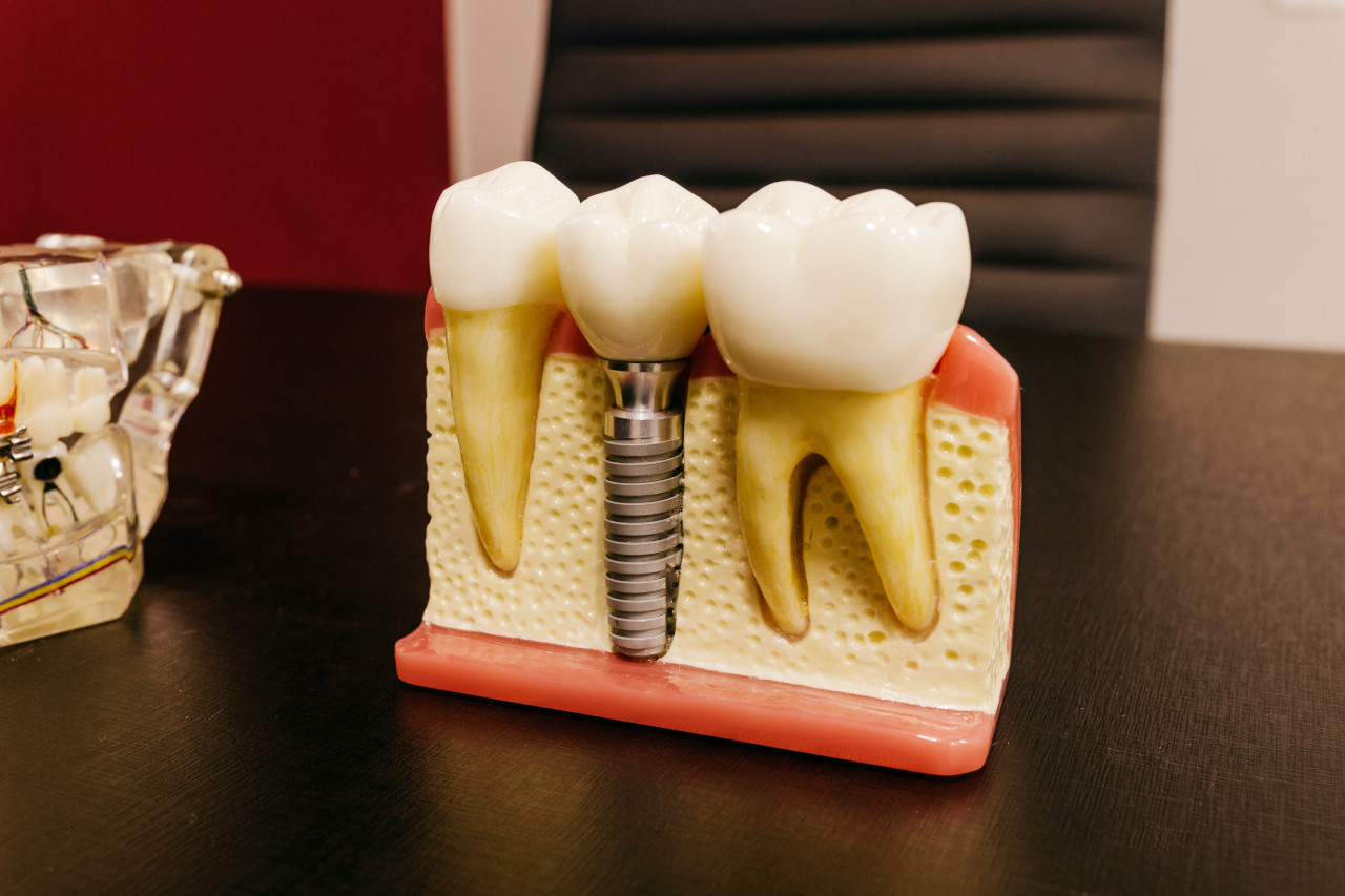 ¿Cómo los implantes dentales pueden mejorar la apariencia de tu sonrisa?