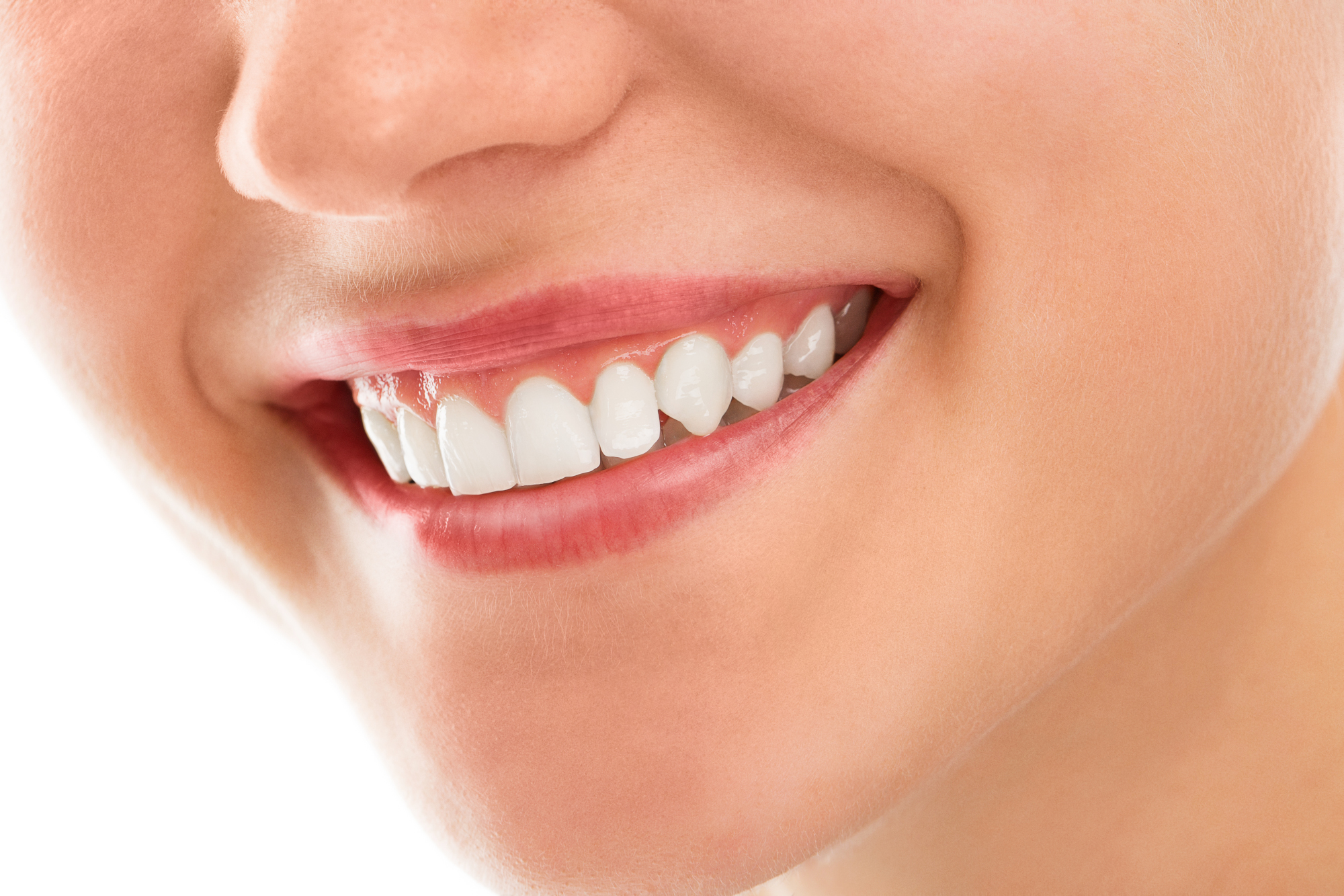 Carillas dentales: la solución para lucir una sonrisa radiante sin cirugía