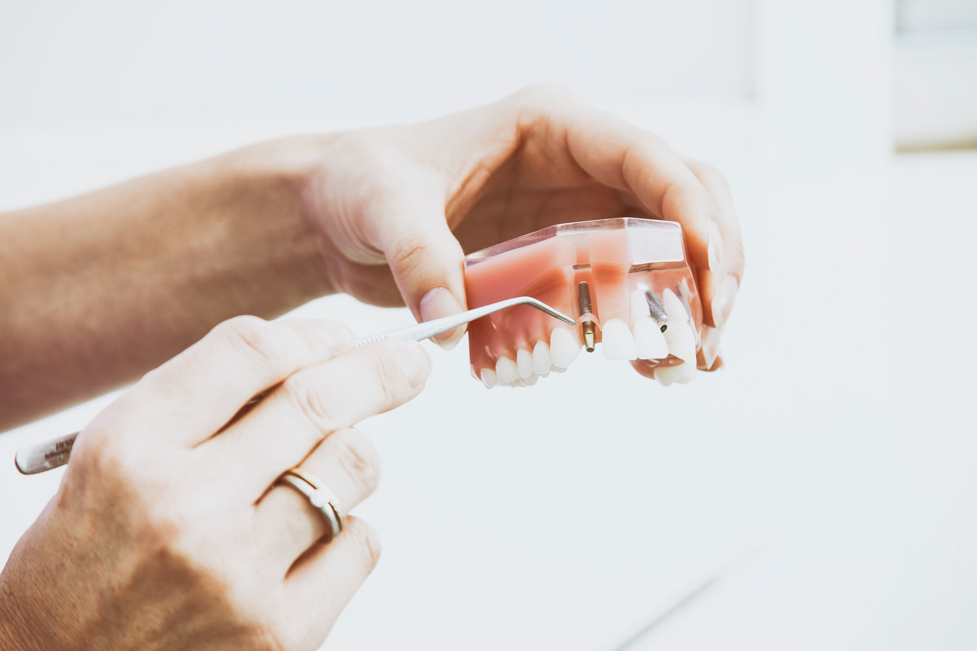 Los implantes dentales y la odontología moderna